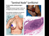 Bröstpatologi