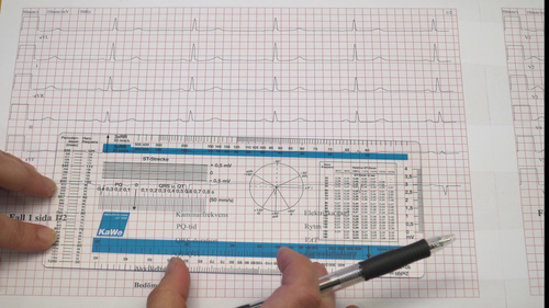 EKG-tolkning