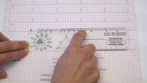 EKG-tolkning BMA