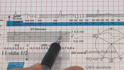 EKG-ST-hjning