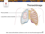 Förhandsvisning (thumbnail) från videon Praktiska Öningar T11 Thoraxdrän