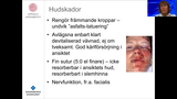 Förhandsvisning (thumbnail) från videon Multidisciplinär föreläsning Kraniofacialt trauma
