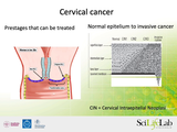 Förhandsvisning (thumbnail) från videon Ulf Gyllensten - Etiology of cervical cancer and development of effcient screening biomarkers Part II