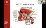 Förhandsvisning (thumbnail) från videon Prostatacancer del 1/3