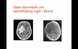 Förhandsvisning (thumbnail) från videon Stroke