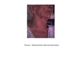 Förhandsvisning (thumbnail) från videon Struma och Tyreotoxicos