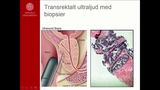 Förhandsvisning (thumbnail) från videon Prostatacancer