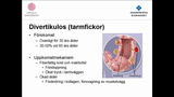 Förhandsvisning (thumbnail) från videon Nedre gastrointestinal kirurgi Del 5