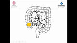 Förhandsvisning (thumbnail) från videon Nedre gastrointestinal kirurgi Del 7