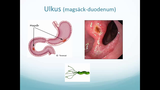 Förhandsvisning (thumbnail) från videon Övre gastrointestinal kirurgi Del 2
