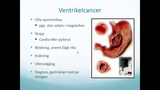 Förhandsvisning (thumbnail) från videon Övre gastrointestinal kirurgi Del 3